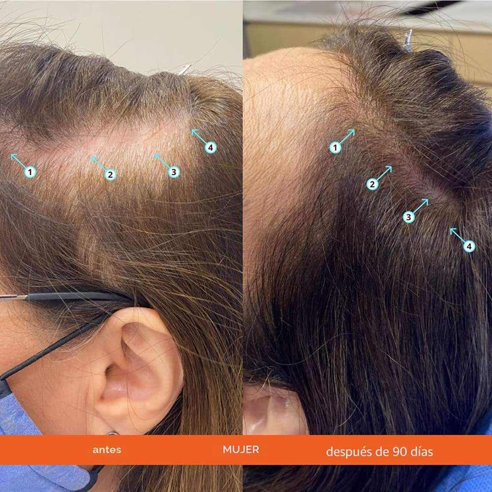 Resultados con Revita Extra Strength
